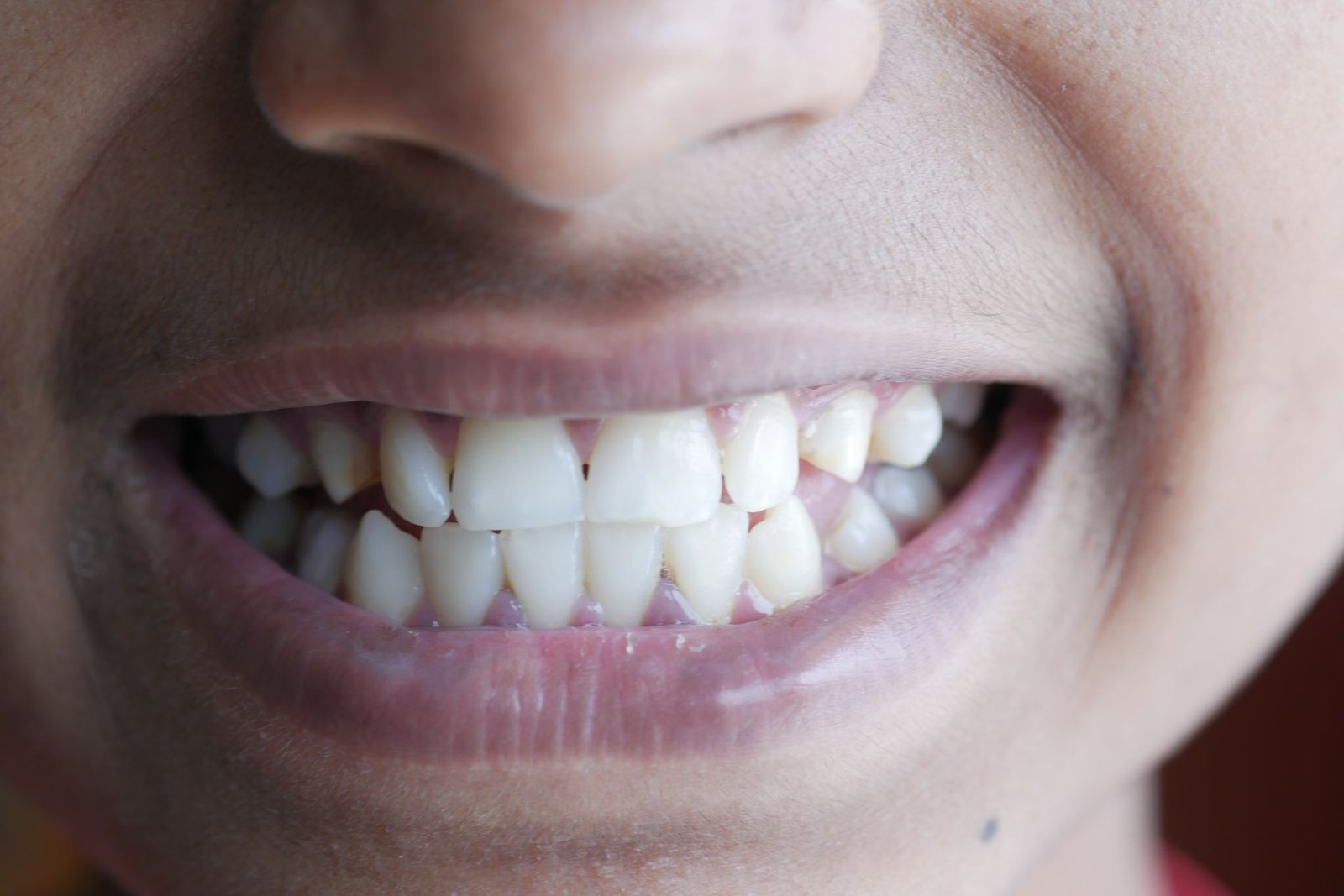 Close-up of a person smiling, showing natural upper and lower front teeth